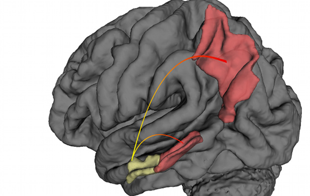 La nouvelle méthode de traitement d'images appliquée à l'imagerie fonctionnelle par résonance magnétique a permis de visualiser la progression de la maladie d’Alzheimer : la pathologie démarre dans le cortex entorhinal (en jaune), avant de se répandre dans d’autres aires cérébrales (en rouge).